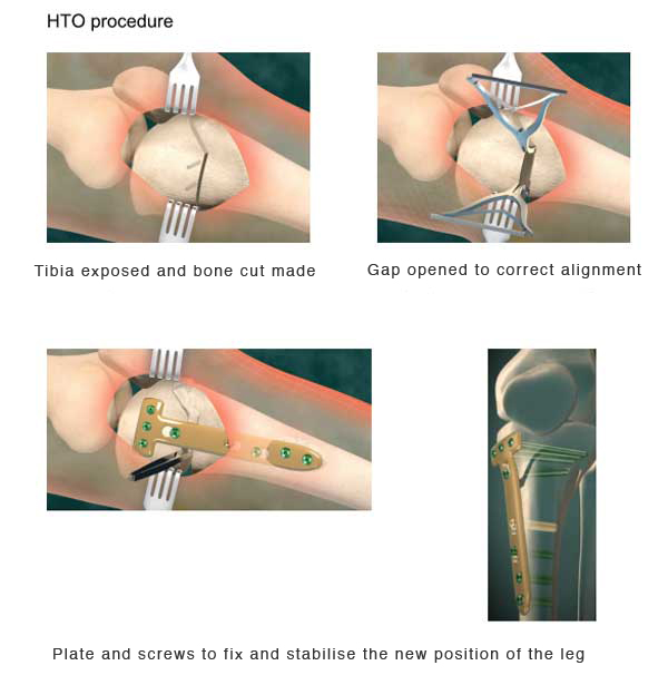 image showing HTO-knee surgery procedure